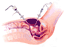 Laparoscopic myomectomy
