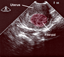 Diagnosis of uterine fibroids