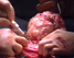 Abdominal myomectomy - removal of uterine fibroids